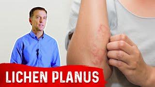 Lichen Planus: Best Remedy