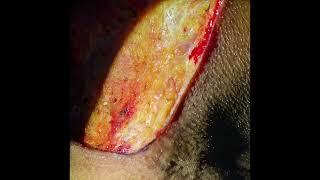Neck dissection, complete video, Dr.Nitin Sharma & Dr.Abhishek Malhotra