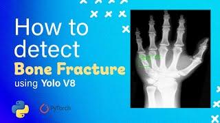 How to Detect Bone Fracture using Deep Learning