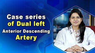 Case series of Dual left anterior descending artery