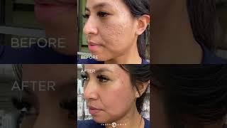 #shorts ACNE SCAR COMBINATION | HYBRID LASER + CO2 ABLATIVE | Dr. Jason Emer