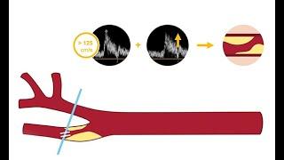 Identifying carotid artery disease with ultrasound