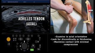 Ultrasound Tutorial: MSK Series: Achilles Tendon | Radiology Nation