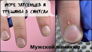 Мужской маникюр  Море заусенцев и трещины в синусах