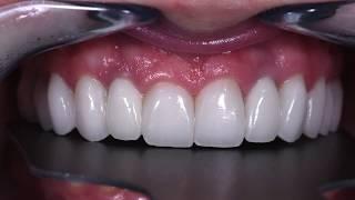 Dental Implants Procedure in Midtown NYC - Dr. Alex Rubinov - Cosmetic Dentist in NYC