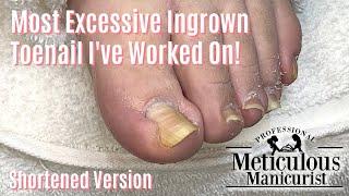 Most Extreme Ingrown Toenail Salon Pedicure - Shortened