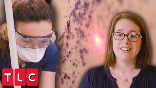 Dr. Emma Treats Very Rare Skin Condition With Laser | Save My Skin