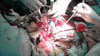 Mitral Valve Replacement in Marfan Syndrome