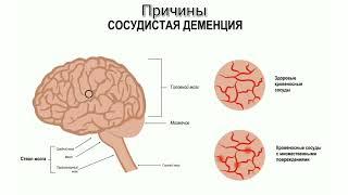 Деменция. Старческий маразм.