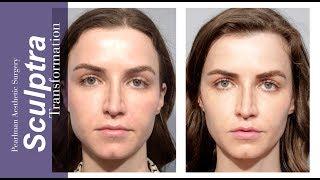 SCULPTRA  The Liquid Facelift! - Pearlman Aesthetic Surgery