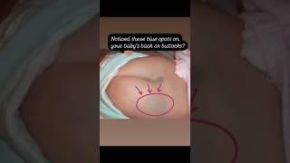 Mongolian spots ?are usually found on the lower back, buttocks, shoulders #medical#learning#viral