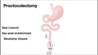 HCC 1475 10m  Surgical Anatomy Proctocolectomy