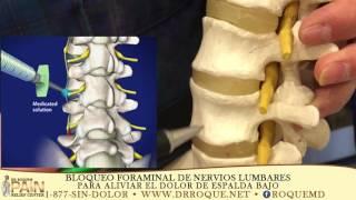 Selective Lumbar Foraminal Block, L2-L3