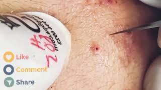 Acne RELAX|24 pickel ausdrücken Sac Dep Spa brufoli 2025 blackheads new punti neri video treatment 