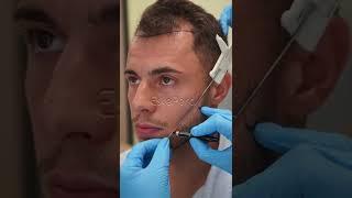 Best Sapphire FUE Hair Transplant Service in Turkey - İstanbul #hairtransplant