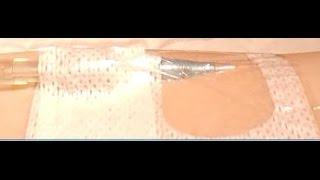 Peripheral IV Dressing Change: Tegaderm™ I.V. Advanced
