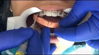 How Braces are Put On Teeth - New Faster Technique (Indirect Bonding)