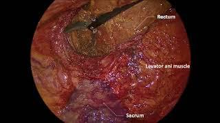 Step by step approach in laparoscopic total intersphincteric resection in rectal cancer