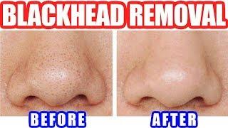 How to Remove Blackheads: Best Blackhead Removal Easy Tool