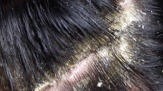 Dandruff scratching removal on head using black combing#184