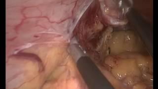 bypassed sleeve gastrectomy by WAEL TOBAR MD