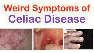 Weird Symptoms of Celiac Disease | Atypical Clinical Features