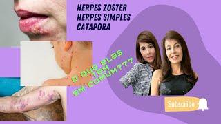 VOCÊ JA TEVE HERPES? HERPES ZOSTER? CATAPORA???