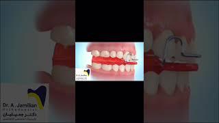 Treatment of lower jaw  deficiency with functional appliance #brace#functional#orthodontic#dentition