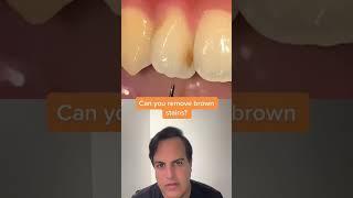 Cleaning brown spots on teeth #CleanTeeth #Teeth#DentalHygiene#WhiteTeeth