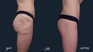 Awesome Lower Body Lift | Before and After Video | Dr. David Stoker