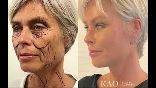 Dr. Kao Ponytail Facelift in Denmark at Aleris-Hamlet (English Subtitles)