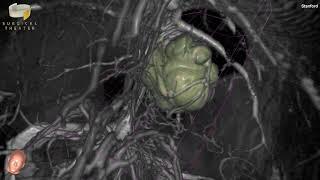 Stanford Neurosurgery Virtual Reality Lab's Anatomy in 3D: MENINGIOMA