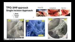 Triple Pelvic Osteotomy in Depth Surgery Review, Development Dysplasia of Hip Management