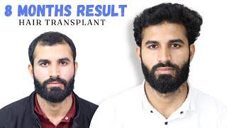 Hair Transplant in Ujjain | Cost of Hair Transplant in Ujjain | Hair Transplant Doctor in Ujjain