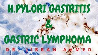 H. PYLORI GASTRITIS AND GASTRIC LYMPHOMAII GIT II ROBBINS 10TH E II PATHOLOGY LECTURES II