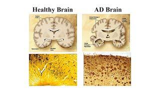 Neurological Issues in Down Syndrome and Aging