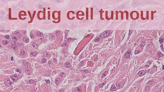 Leydig Cell Tumours of the Testis - Pathology mini tutorial