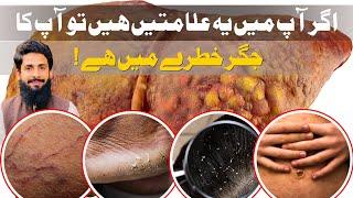 Most Important Signs of Liver Damage | Dr Abubakar Bhutta