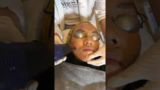 Fractional Laser procedure by Dr. Nadia Elaiza
