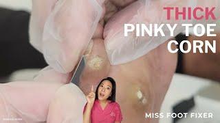 Thick Pinky Toe Corn Removal | So Satisfying to Watch!