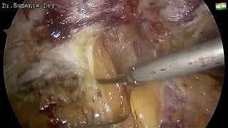 Ventral Hernia & Diastasis Recti: Laparoscopic eTEP RS repair by Dr.Sumanta Dey