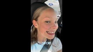How Invisalign® Gives Confidence!