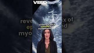 Understanding Pleomorphic Adenoma  Key Insights , #medical #science #dentist