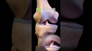 3D View of How ACL Knee Ligaments Tear
