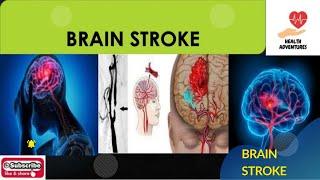 Health ADVENTURES/BRAIN STROKE /HEALTH VEDIOS