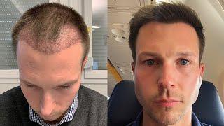 How Much Does A Hair Transplant Cost?