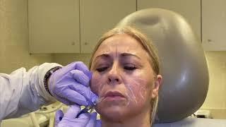 The RHA Collection of Fillers | Schweiger Dermatology Group