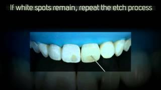 Helping Dentists Succeed: ICON resin infiltration for white spot removal