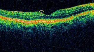 Mastering OCT Interpretation with Dr. Mark Friedberg