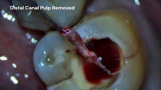 Root Canal Treatment RCT, Access opening, Pulp Stone Removal, Pulp Removal of Lower Molar